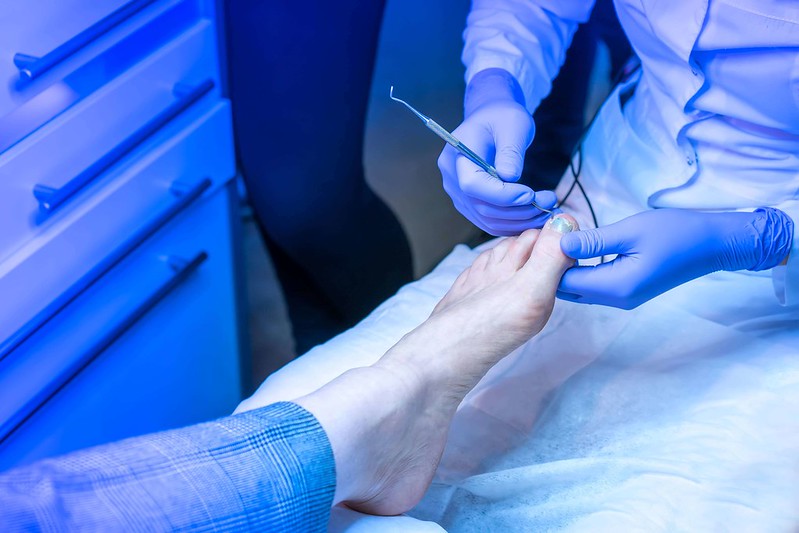 Ingrown-Toenail-surgery